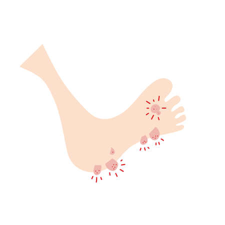 Plantar wart icon. Verruca symbol, foot corn, human papillomavirus sign, HPV infection, clavus pictogram, feet papilloma vector illustrationのイラスト素材