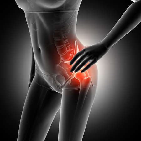 3D render of a female figure holding hip in pain with skeleton highlighted