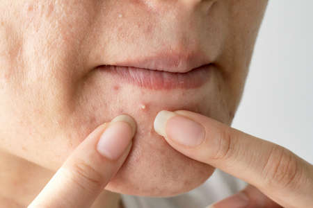 Acne pus, Close up photo of acne prone skin, Woman squeezing her pimple, Removing pimple from her face.の写真素材