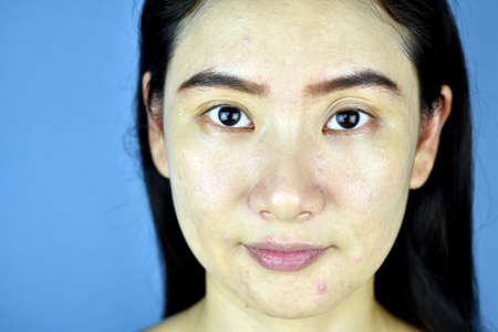 Skin preparing for cosmetic makeup, Nude face with acne scare problem, Asian woman bare skin.