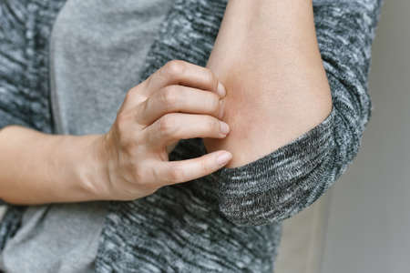 Scratch Skin allergy diseases problem, Close up of atopic dermatitis rash, Female dermatology...