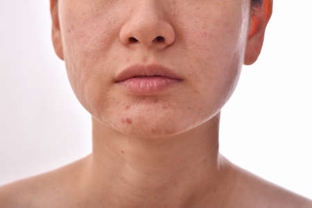 Skin problem with acne diseases, Close up woman face with whitehead pimples, Scar and oily greasy...