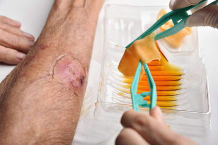 Wound dressing, Doctor cleaning and wash infected wound in chronic diabetes patient with normal saline and povidone iodine, Accidental wound care treatment in elder old man.の写真素材
