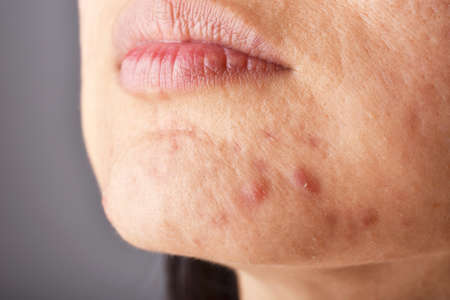 Skin problem with acne diseases, Close up woman face with whitehead pimples on chin, Menstruation...