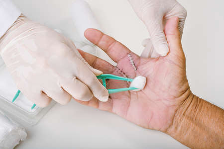 Doctor doing wound dressing care, Hand surgery treatment, Trigger finger stiffness painful, Doctor...