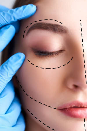 Beautiful young woman with perforation lines on her face before plastic surgery operation....