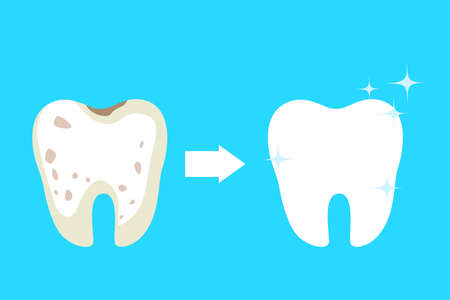 Teeth whitening concept. Tooth become white in dental clinicのイラスト素材