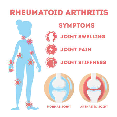 Rheumatism infographic. Bone disease on foot, hand and elbow. Body pain. Damaged joints. Symptoms. Isolated vector illustration in cartoon styleのイラスト素材