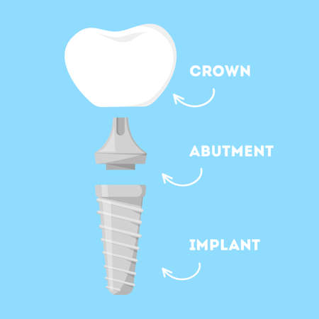 Dental implant structure. Artificial tooth parts. Implant, abutment and realistic crown. Dental restoration. Isolated vector illustration in cartoon styleのイラスト素材