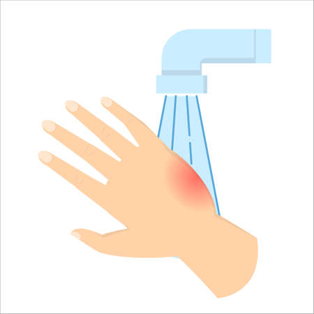 Burned skin on the hand. First aid after the accident. Put hand under the cool water. Red area, pain from flame. Isolated vector illustration in cartoon styleのイラスト素材