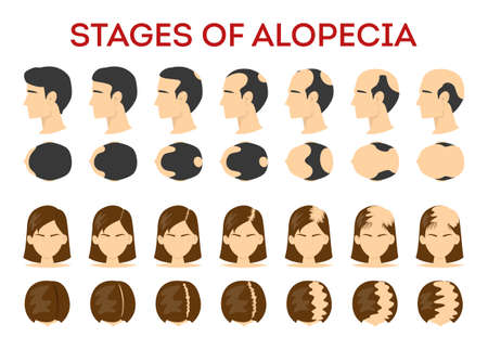 Alopecia stages set. Hair loss, balding process. Female and male alopecia. Isolated vector illustration in cartoon styleのイラスト素材