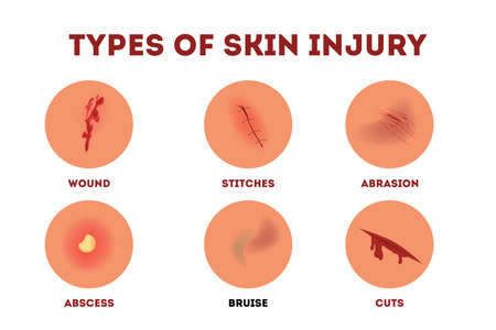 Set of vector illustration of physical body injury. Isolated cartoon style collection with different kinds of skin injury in the human body. Isolated illustration of painful skin damageのイラスト素材