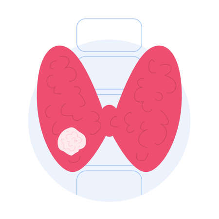Thyroid cancer signs. Idea of health and medical treatmentのイラスト素材