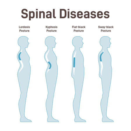 Diseases of the spine. Lordosis, kyphosis, flat-back and sway-backのイラスト素材