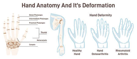 Human hand bones and its deformations. Anatomical structureのイラスト素材