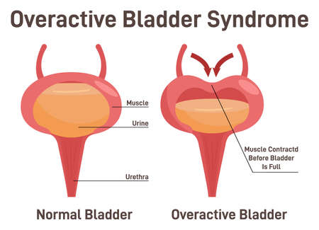 Overactive bladder syndrom. Normal bladder and bladder with urinaryのイラスト素材