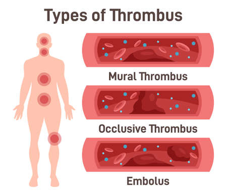 Thrombus types. Arteriosclerosis, infarct, ischemia, thrombosis disease.のイラスト素材