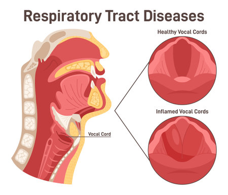 Upper respiratory tract disease. Laryngitis, inflammation of the vocalのイラスト素材