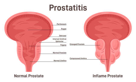 Prostatitis. Pathological disruption of male gland with enlargedのイラスト素材