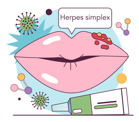 Herpes simplex virus. Herpes on the human lips. Dermatologicalのイラスト素材