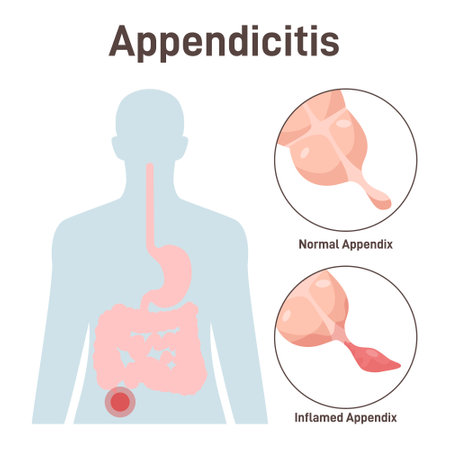 Appendicitis. Appendix inflammation disease. Anatomical diagram with largeのイラスト素材