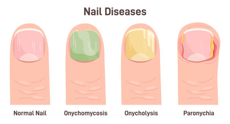 Onychomycosis, onycholysis, paronychia. Nail diseases, nail fungalのイラスト素材