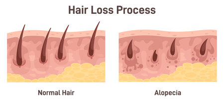 Alopecia. Hair loss, balding process. Cross-section anatomical structureのイラスト素材