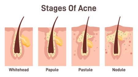 Acne development stages. Inflamed skin pimples. Plugged hair folliclesのイラスト素材