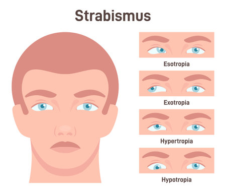 Strabismus. Cross eyed vision condition types. Esotropia, exotropiaのイラスト素材