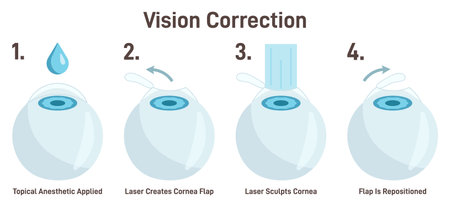 Vision correction. Laser eye surgery. Ophthalmology procedure.のイラスト素材