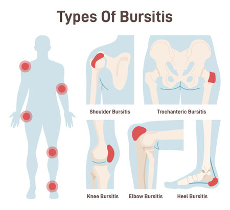 Types of bursitis set. Shoulder, hip, heel, knee and elbow joints inflammation.のイラスト素材