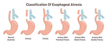 Esophageal atresia types set. Congenital medical condition of tracheaのイラスト素材