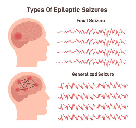 Types of epilepsy. Generalized and focal seizures. Human brainのイラスト素材