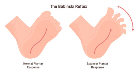 Babinski reflex. Stimulation of the lateral plantar aspect of the foot leadsのイラスト素材