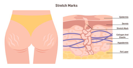 Anatomy of skin with stretch marks. Skin stretches or shrinks quickly.のイラスト素材