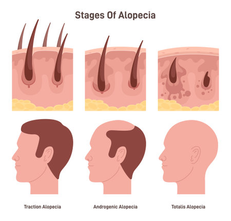 Hair loss stages. Male alopecia or balding process. Man head side viewのイラスト素材