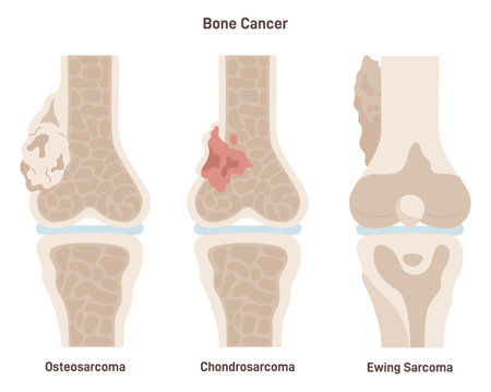 Bone cancer types set. Ewings sarcoma, osteosarcoma and chondrosarcoma.のイラスト素材
