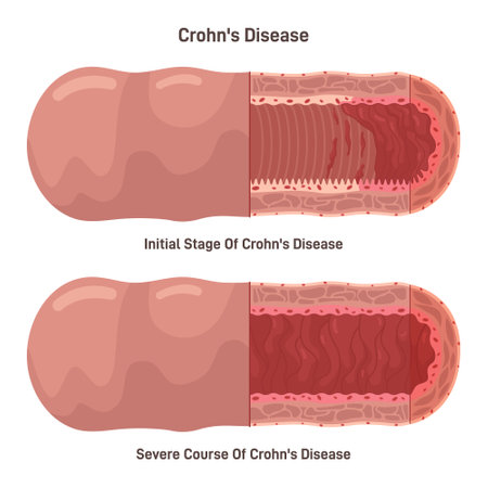 Crohns disease. Chronic, or long-term inflammatory bowel disease.のイラスト素材
