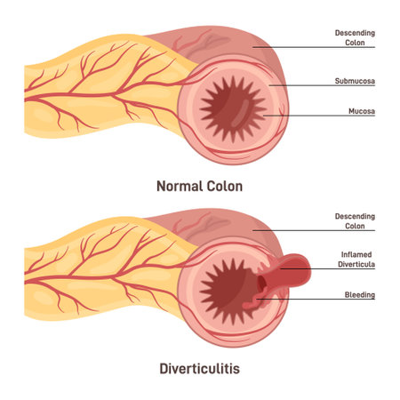 Diverticulitis. Structure and location of polyp, infected or inflamedのイラスト素材
