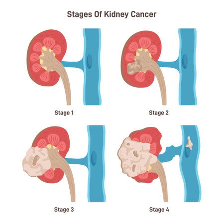 Kidney cancer stages. Malignant tumor is affecting a kidney. Developmentのイラスト素材