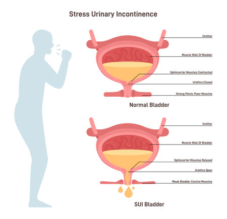 Stress urinary incontinence. Leakage of urine during moments of physicalのイラスト素材