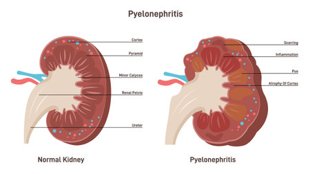 Pyelonephritis. Kidney infection disease, inflammation of organ tissueのイラスト素材