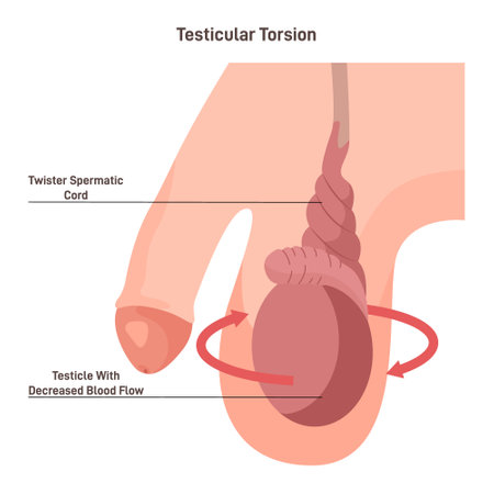 Testicular torsion. Testicle rotation, twisting the spermatic cord and bloodのイラスト素材