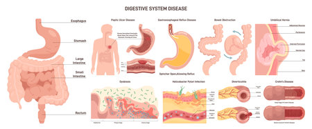 Digestive system diseases set. Gastroenterology disorder, internalのイラスト素材