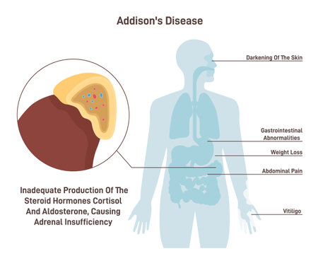 Addisons disease. Symptoms of chronic adrenal insufficiency or hypocortisolismのイラスト素材