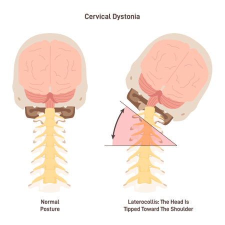 Cervical dystonia. Spasmodic torticollis, inflamatory condition when neckのイラスト素材