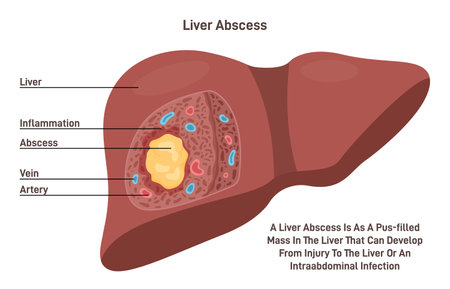 Liver abscess. Human internal organ tissue inflammation and pus formation.のイラスト素材