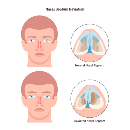Deviated and normal nasal septum. Medical condition of crookedのイラスト素材