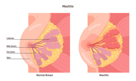 Mastitis. Mammary gland with inflammation of the breast lobularのイラスト素材