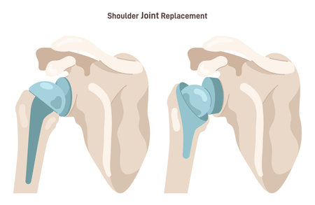 Joint implantation. Injured or distracted human joint replaced with artificial prosthesis made of titanium. Osteoporosis and osteoarthritis treatment surgery. Flat vector illustrationのイラスト素材